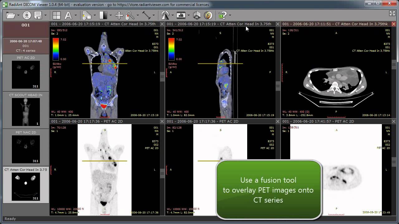 RadiAnt DICOM Viewer  программа
